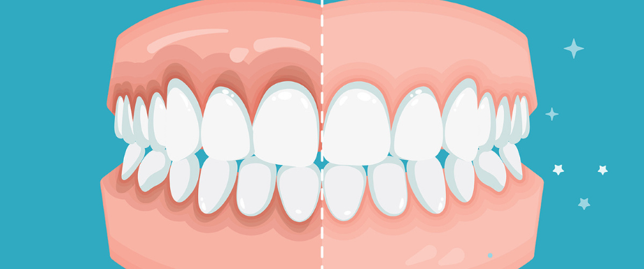 Diabetes and Oral Health problems