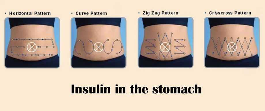 How to do an Insulin shot in the stomach