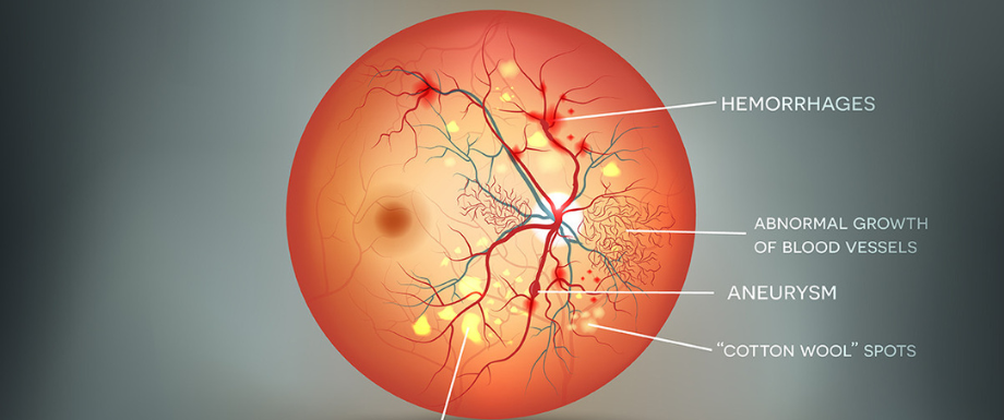 What is Diabetic Retinopathy and what are the best treatment options?