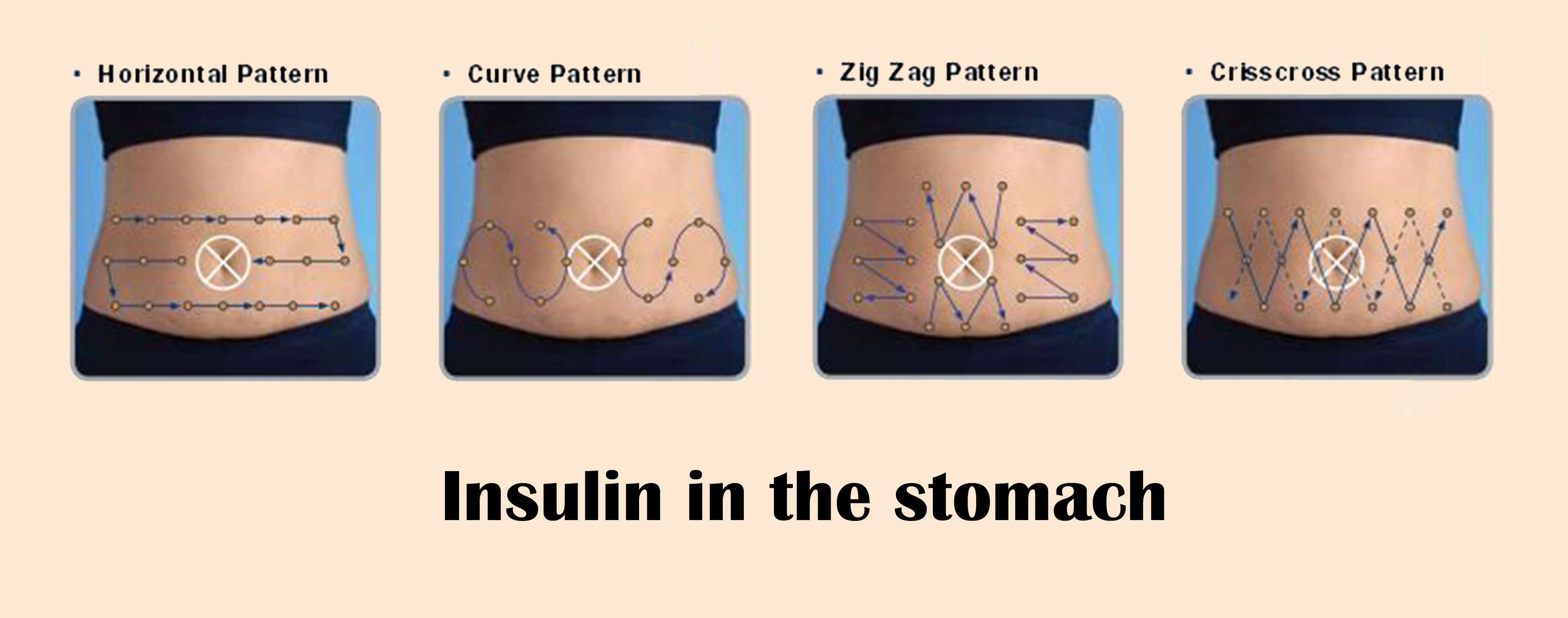 How to do an Insulin shot in the stomach