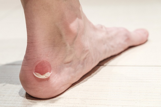 Diabetic Blisters On Feet