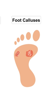 foot calluses