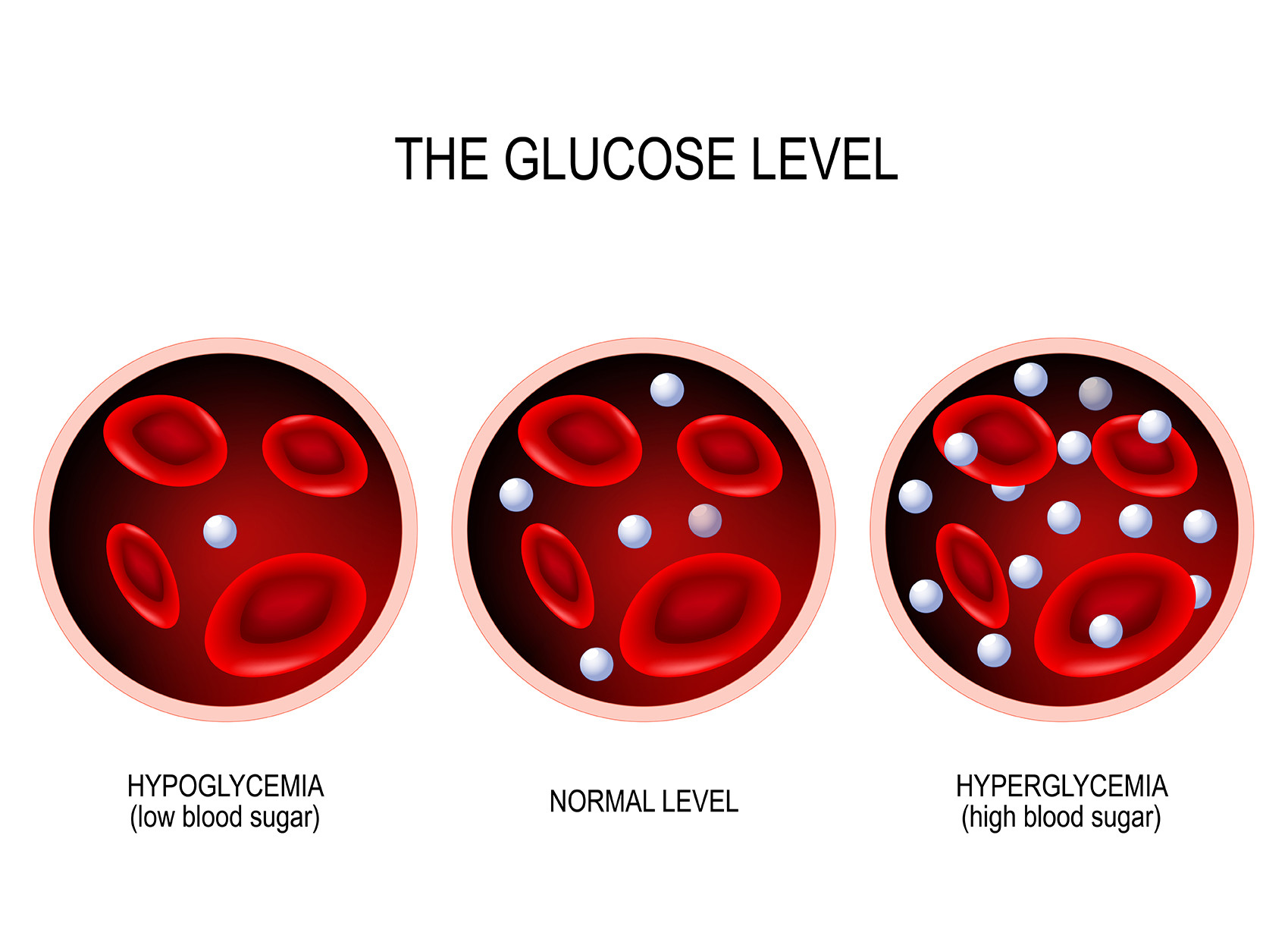 Illustration of high sugar levels