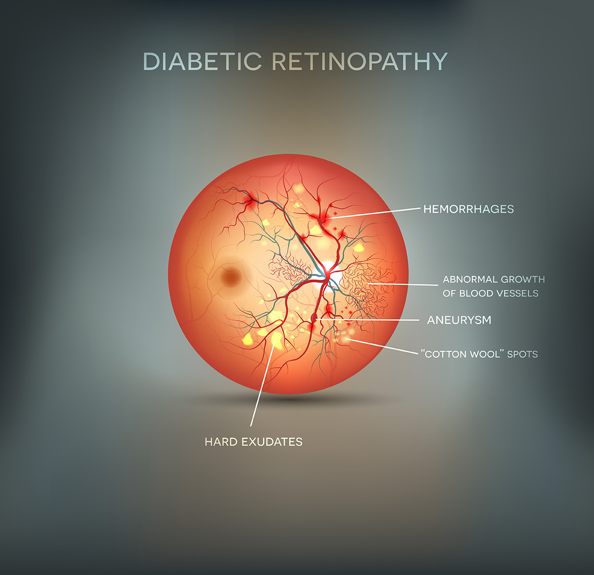 Illustration of diabetic retinopathy