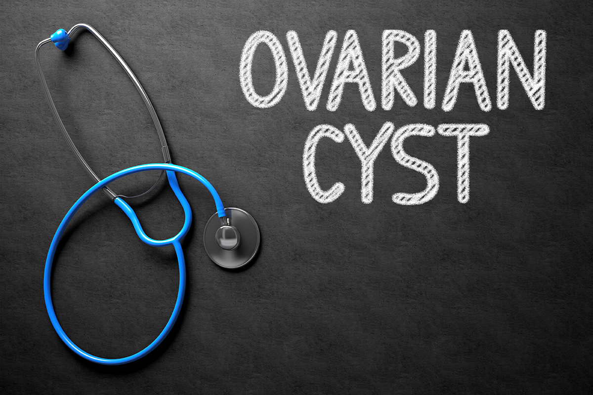 Ovary cyst