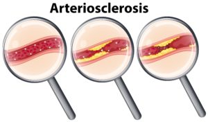 Arteriosclerosis Symptoms