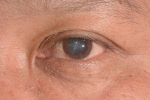 Diabetic cataract