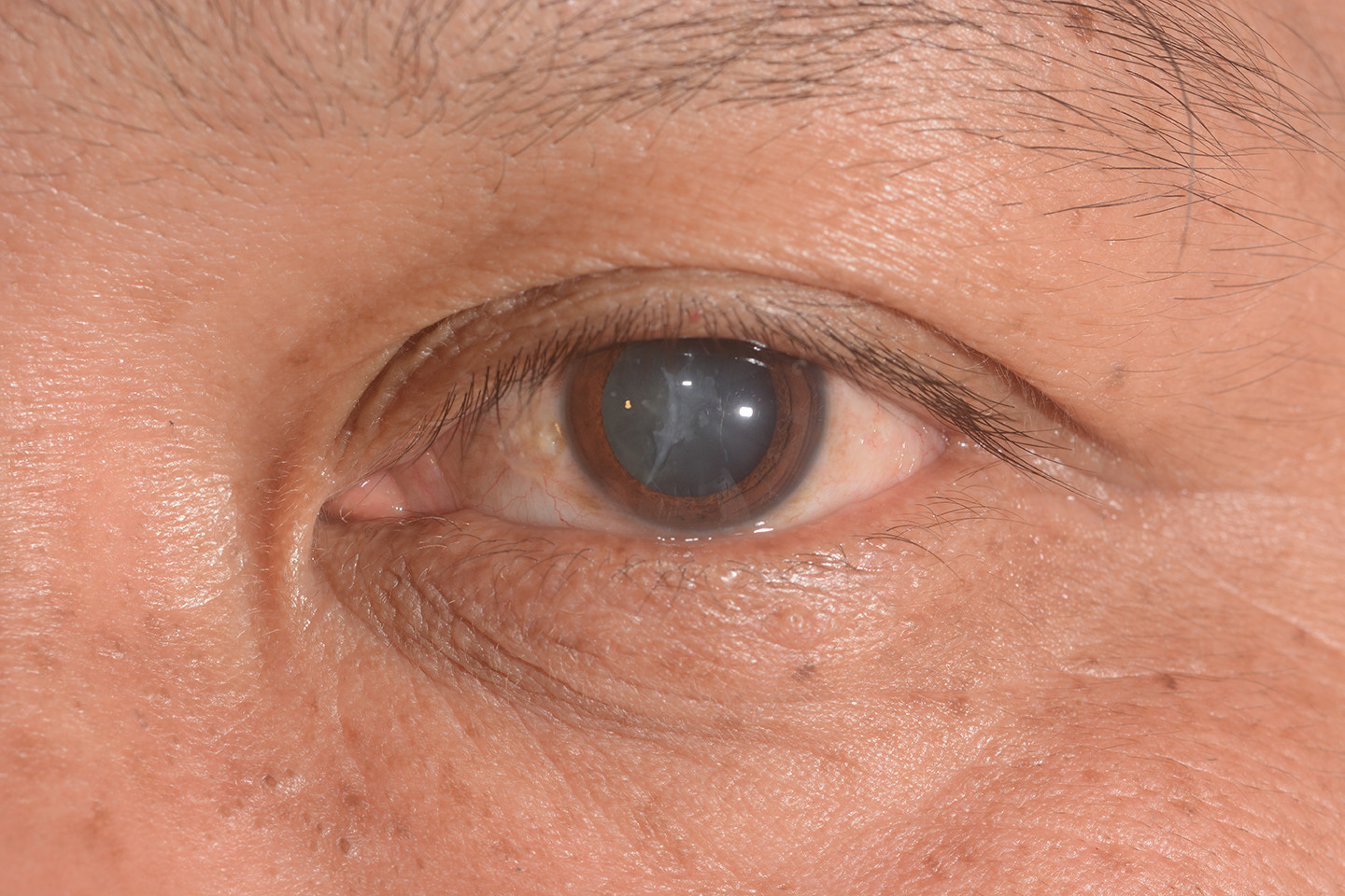 Diabetes and Eyes: Symptoms of Diabetic Cataract