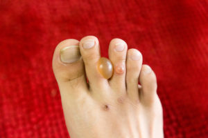 Diagnosis of diabetic blisters on feet