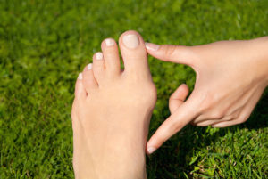 Symptoms of bunions in feet
